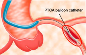 What is catheter PTCA treatment Kossel Medtech