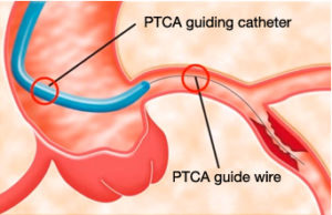 pta balloon catheter