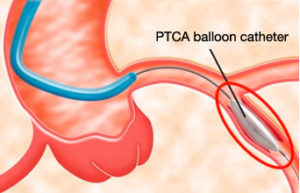 pta balloon catheter