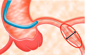 pta balloon catheter