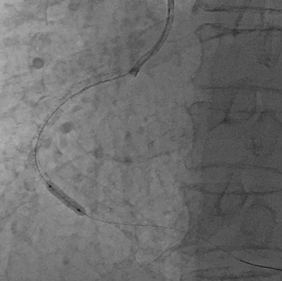 PTCA BALLOON DILATATION CATHETER