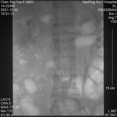 PTA BALLOON CATHETE