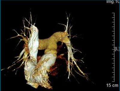 PTCA BALLOON DILATATION CATHETER