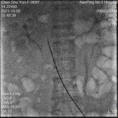 pta balloon catheter