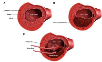 pta balloon catheter