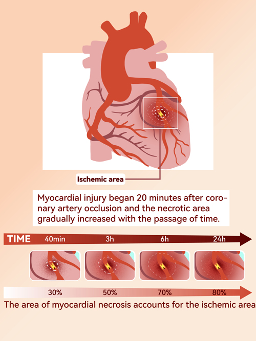 ptca balloon catheter