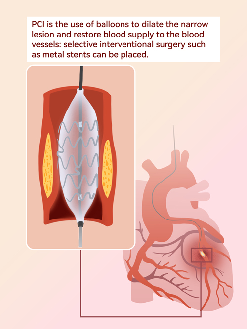 stent system