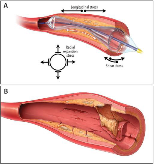 PTA-Balloon-Dilatation-Catheter