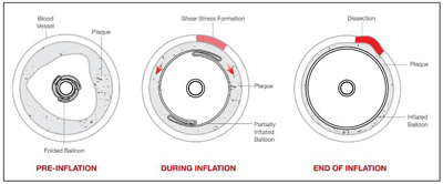 PTA-Balloon-Dilatation-Catheter1