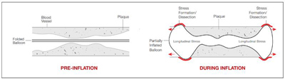 PTA-Balloon-Dilatation-Catheter2